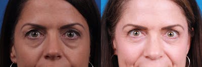 Eyelid Surgery Before & After Gallery - Patient 295029 - Image 1