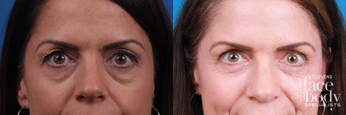 Eyelid Surgery Before & After Gallery - Patient 111855 - Image 1