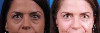 Eyelid Surgery Before & After Gallery - Patient 111855 - Image 1
