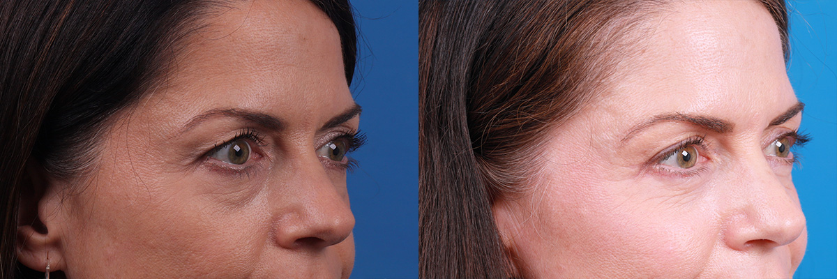 Eyelid Surgery Before & After Gallery - Patient 111855 - Image 2