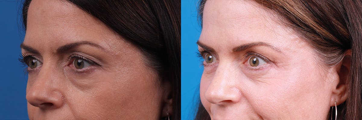 Eyelid Surgery Before & After Gallery - Patient 295029 - Image 3