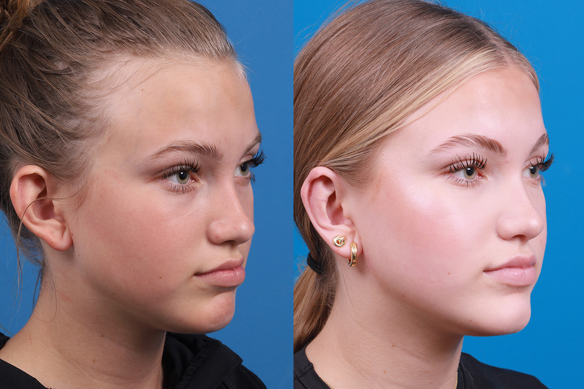 Ear Surgery Before & After Gallery - Patient 394515 - Image 2