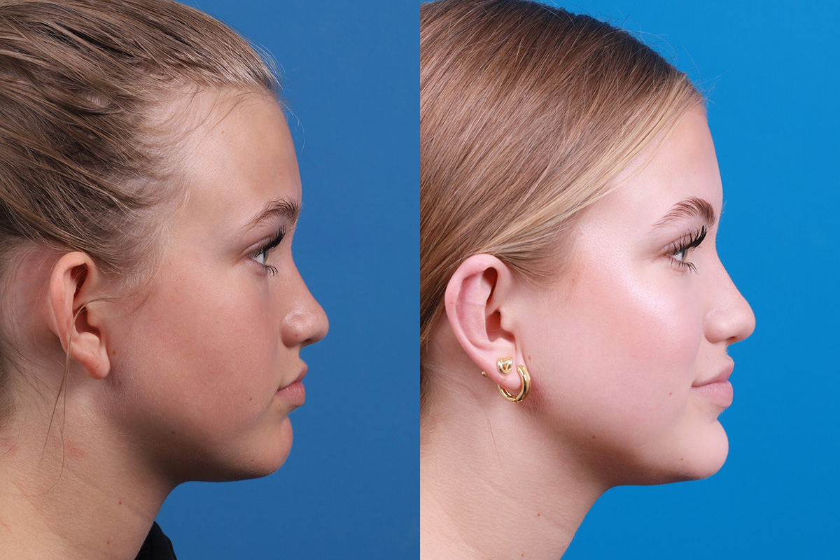 Ear Surgery Before & After Gallery - Patient 394515 - Image 3