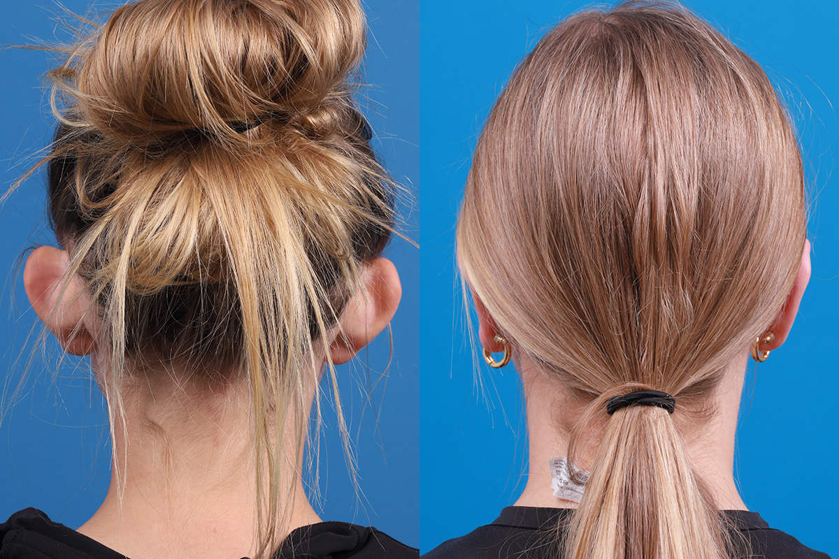 Ear Surgery Before & After Gallery - Patient 394515 - Image 4