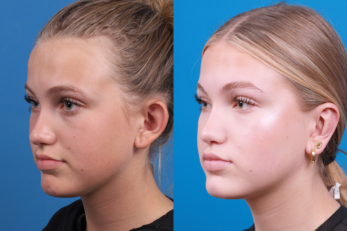 Ear Surgery Before & After Gallery - Patient 394515 - Image 5