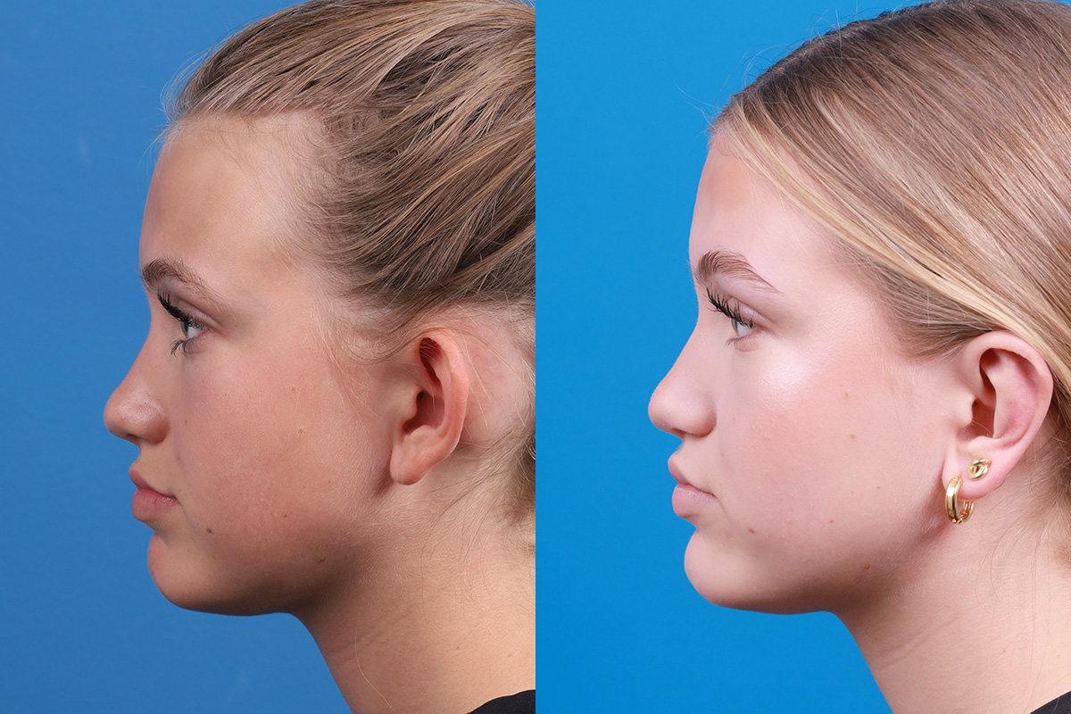Ear Surgery Before & After Gallery - Patient 394515 - Image 6