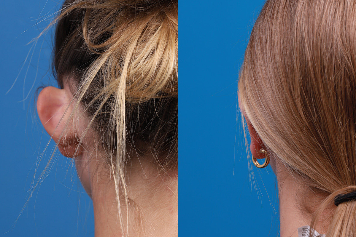 Ear Surgery Before & After Gallery - Patient 394515 - Image 7