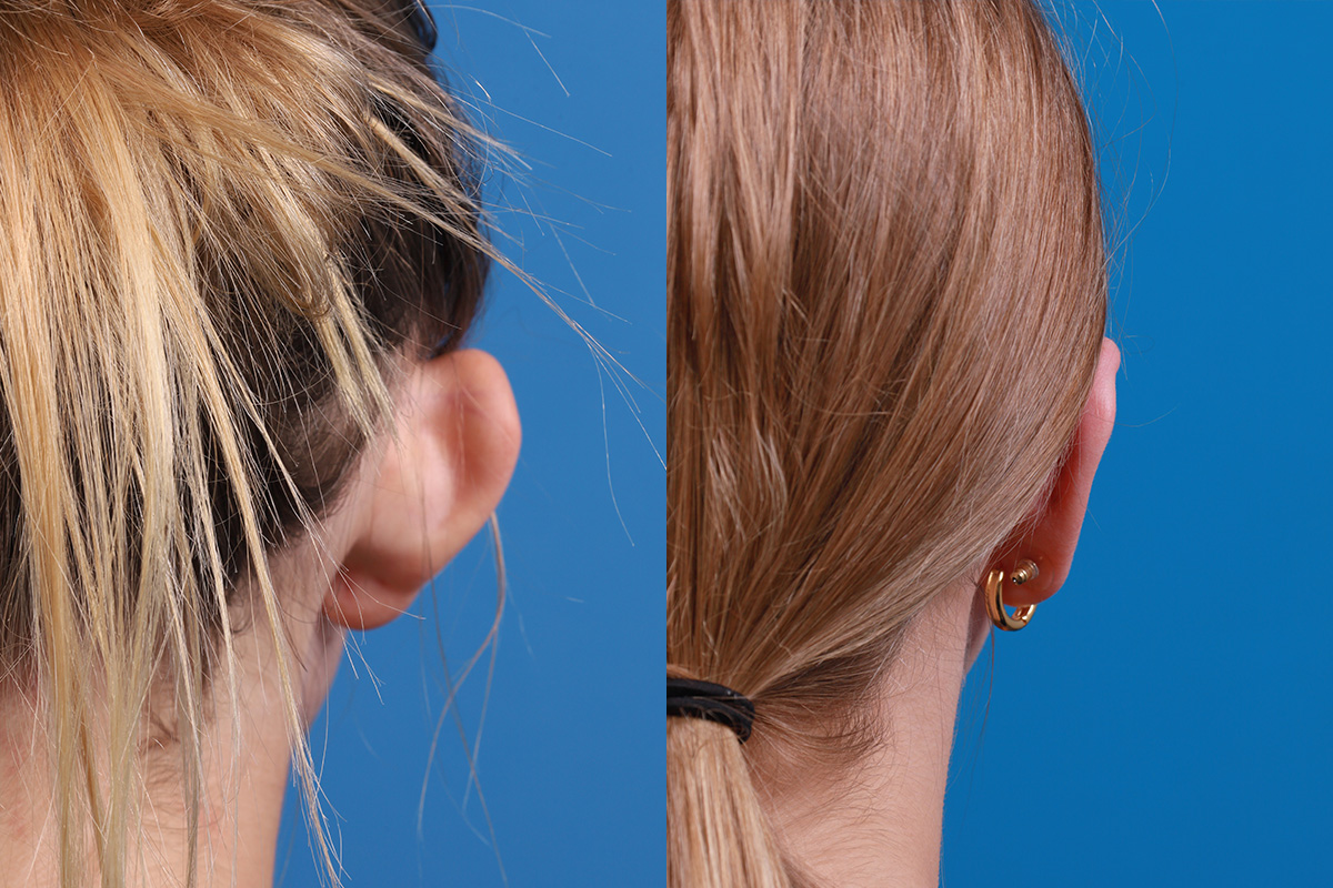 Ear Surgery Before & After Gallery - Patient 394515 - Image 8