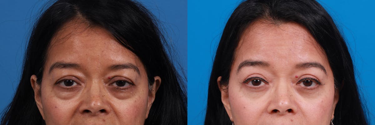 Eyelid Surgery Before & After Gallery - Patient 259619 - Image 1
