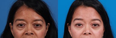Eyelid Surgery Before & After Gallery - Patient 259619 - Image 1