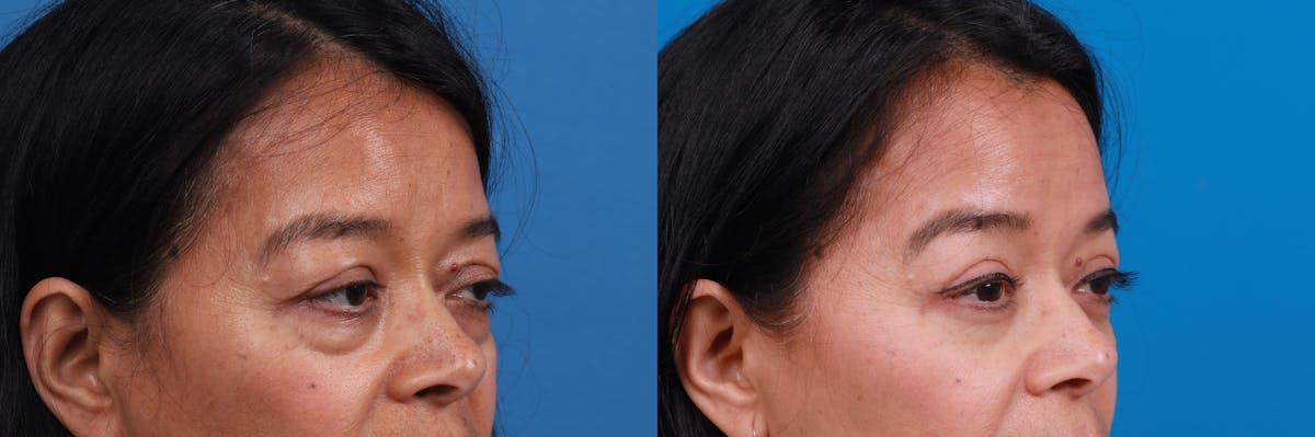 Eyelid Surgery Before & After Gallery - Patient 259619 - Image 2