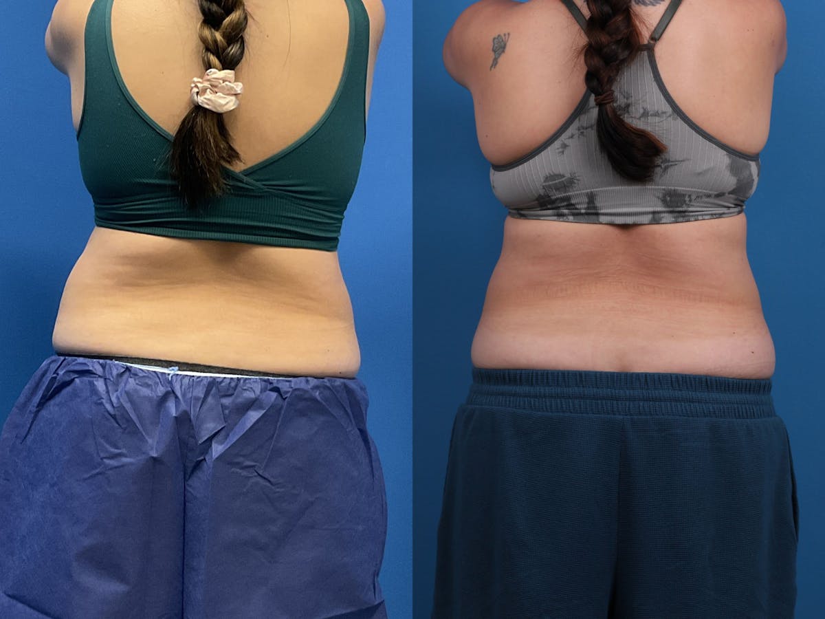 CoolSculpting Before & After Gallery - Patient 605682 - Image 5