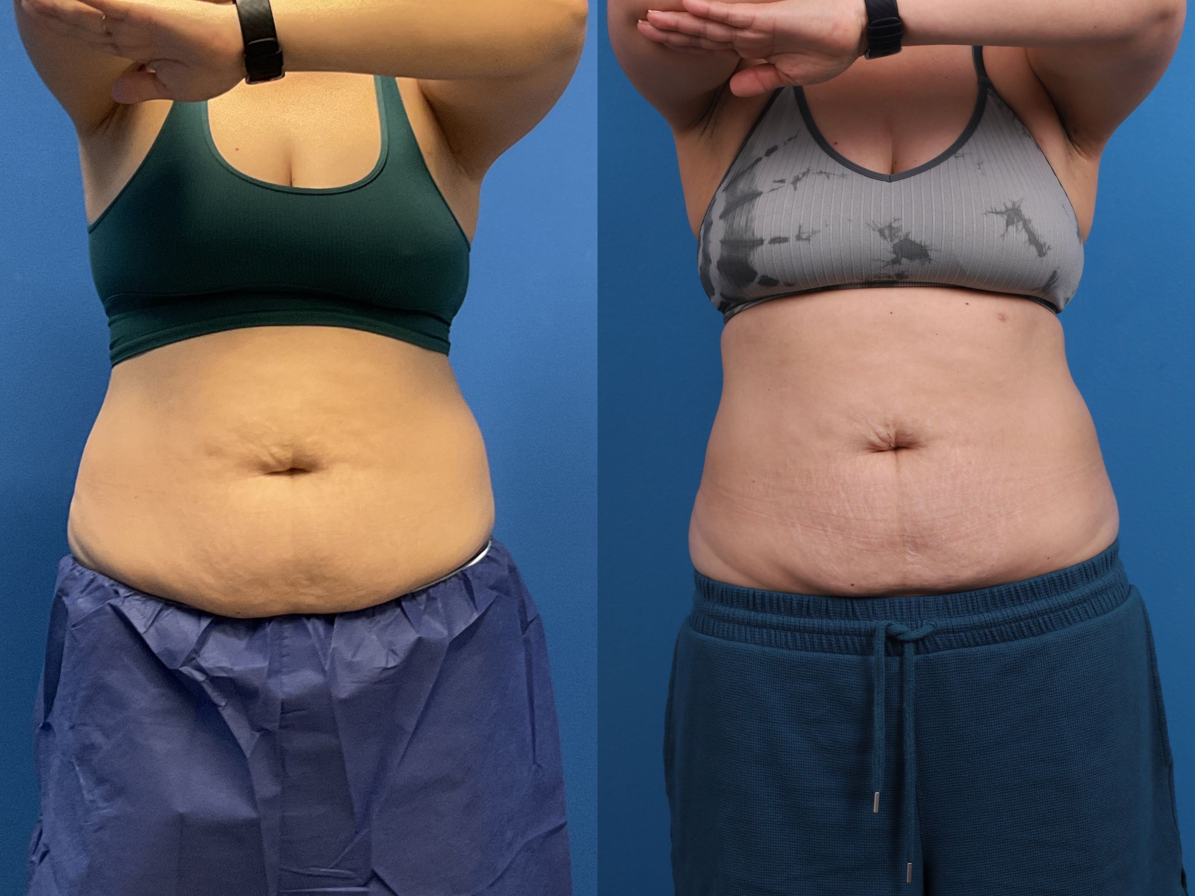 CoolSculpting Before & After Gallery - Patient 107870 - Image 1