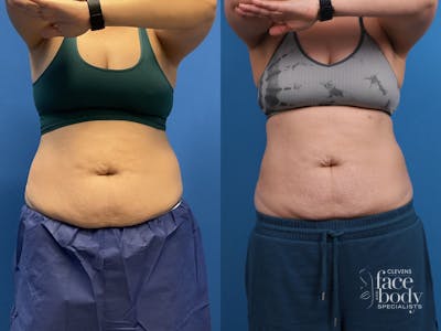 CoolSculpting Before & After Gallery - Patient 107870 - Image 1
