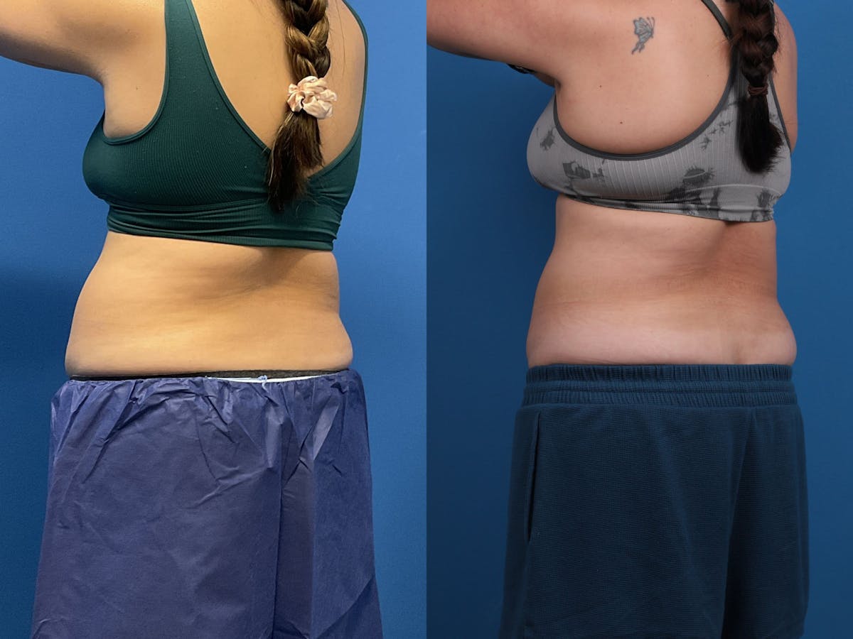 CoolSculpting Before & After Gallery - Patient 605682 - Image 4