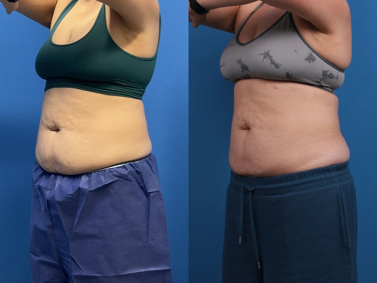 CoolSculpting Before & After Gallery - Patient 605682 - Image 2