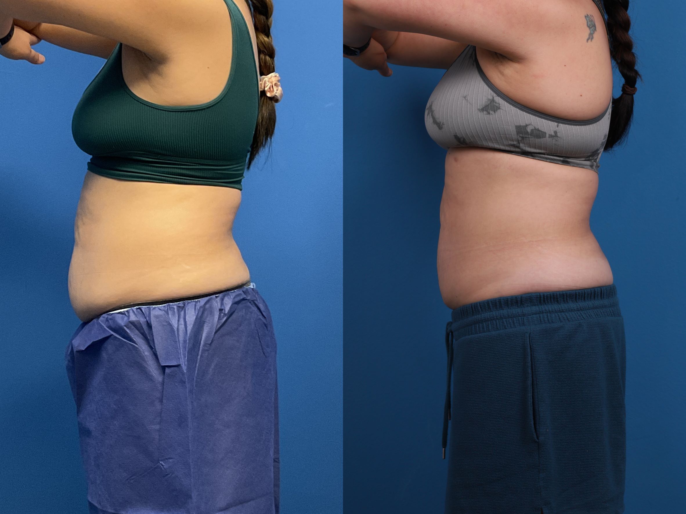 CoolSculpting Before & After Gallery - Patient 107870 - Image 3