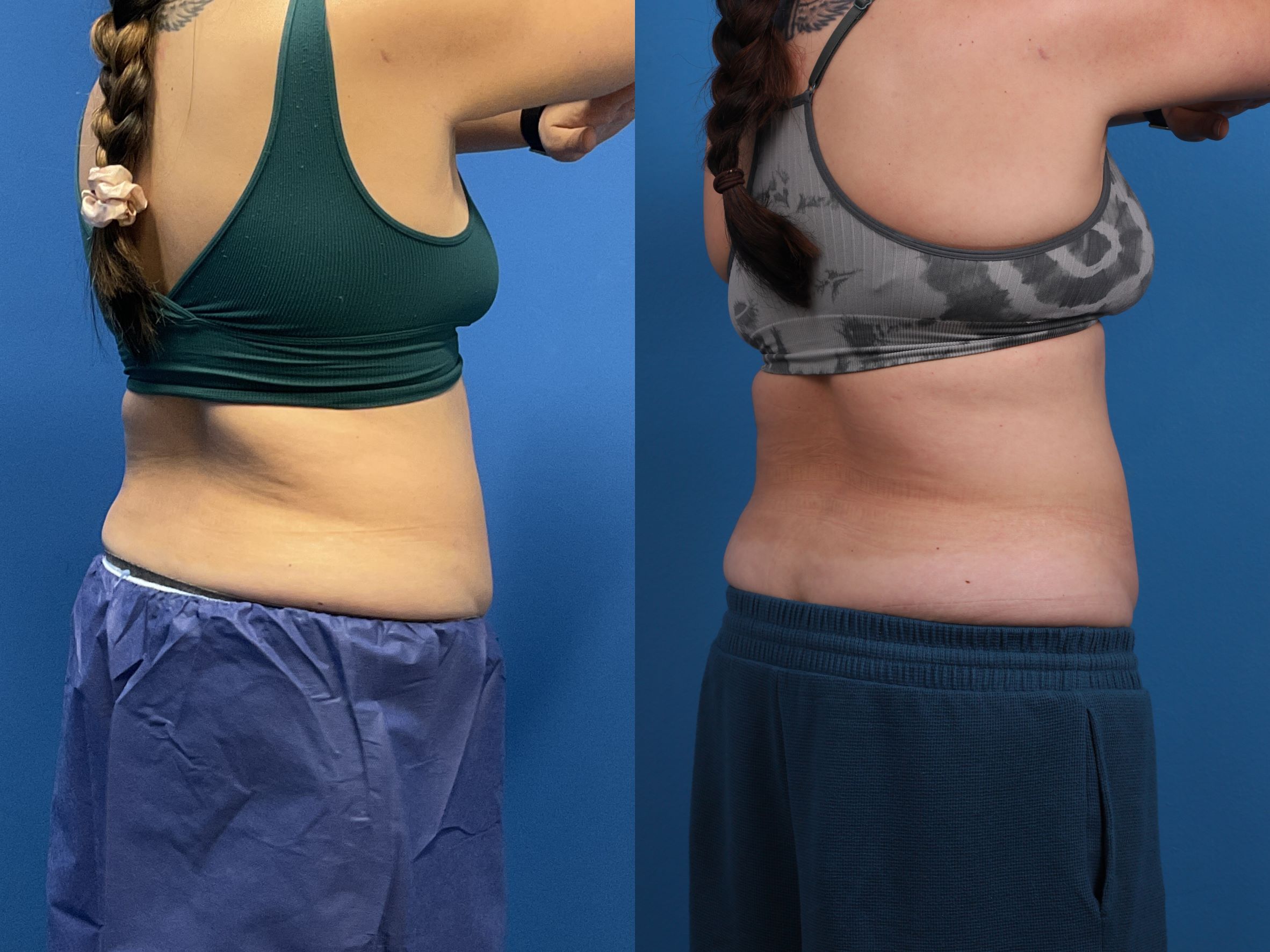 CoolSculpting Before & After Gallery - Patient 107870 - Image 6