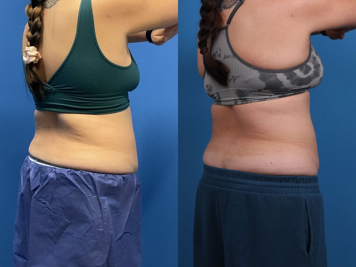 CoolSculpting Before & After Gallery - Patient 605682 - Image 6