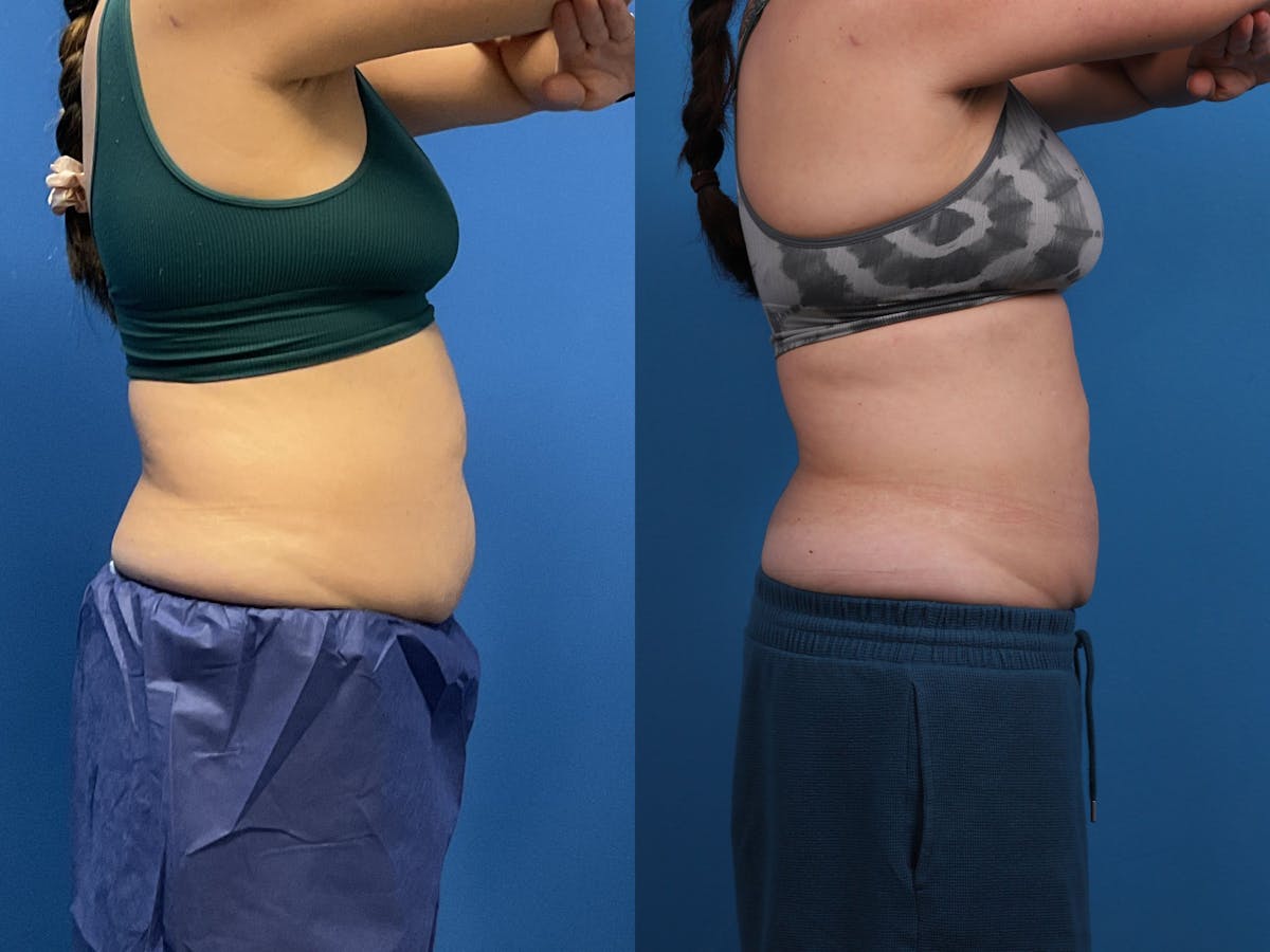 CoolSculpting Before & After Gallery - Patient 605682 - Image 7