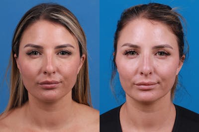 Rhinoplasty Before & After Gallery - Patient 354909 - Image 1