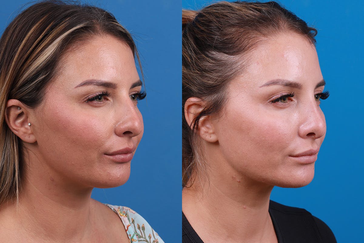 Rhinoplasty Before & After Gallery - Patient 354909 - Image 2