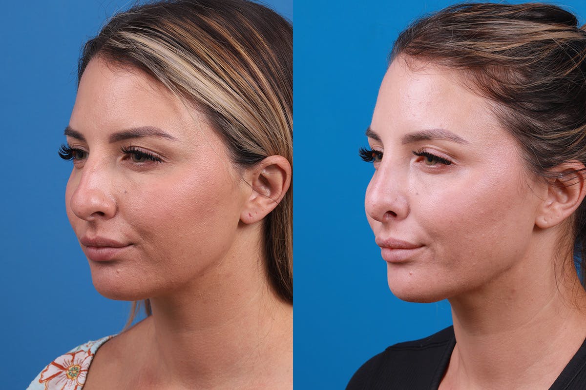 Rhinoplasty Before & After Gallery - Patient 354909 - Image 4