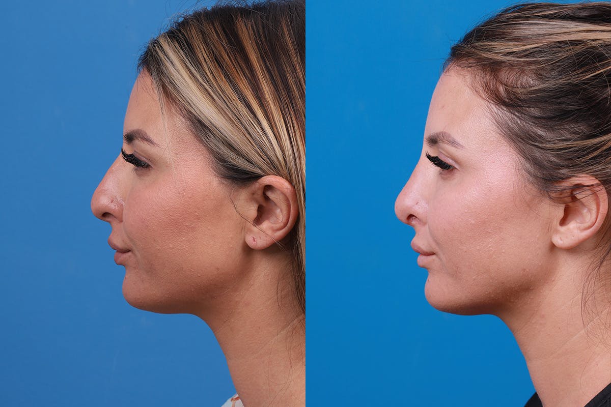 Rhinoplasty Before & After Gallery - Patient 354909 - Image 5