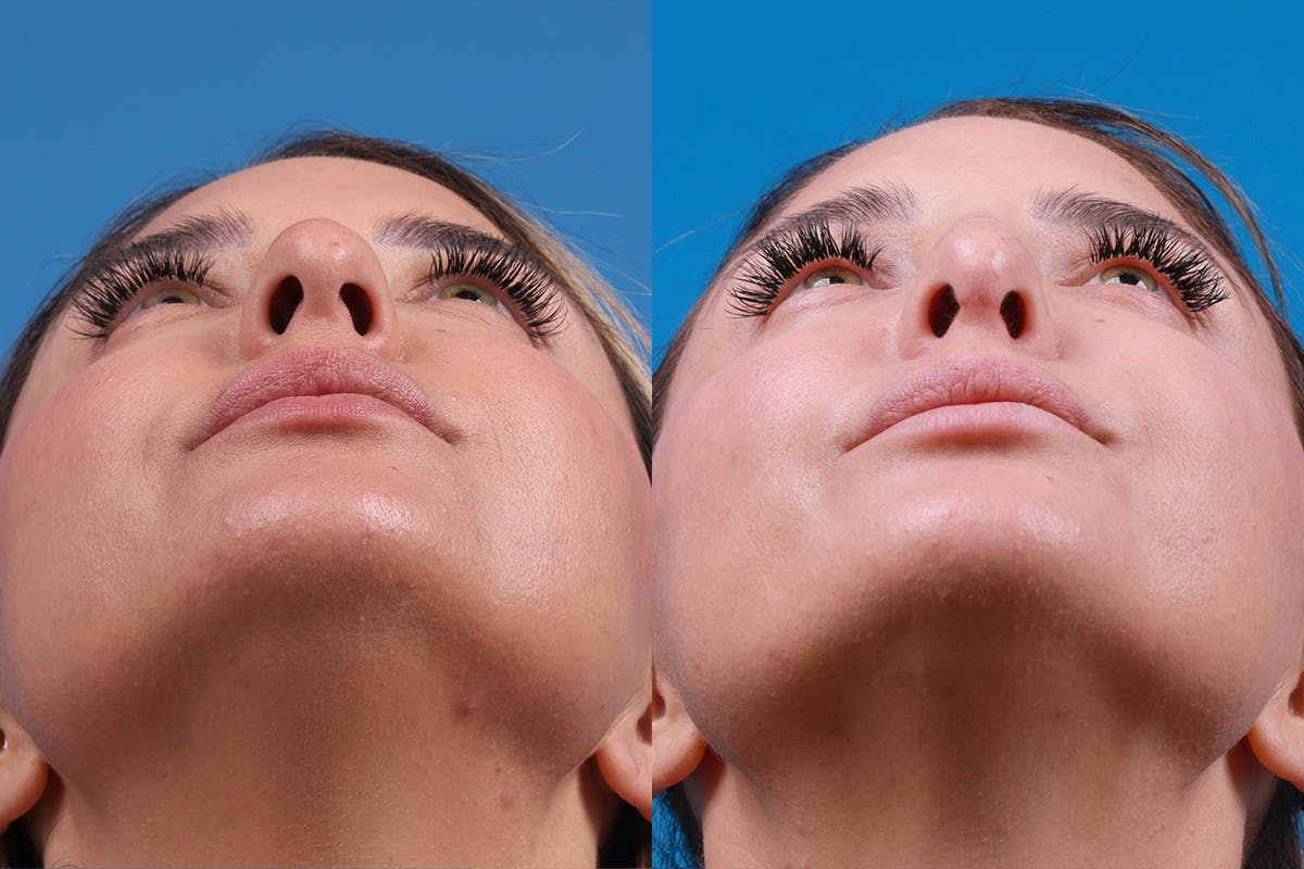 Rhinoplasty Before & After Gallery - Patient 354909 - Image 6
