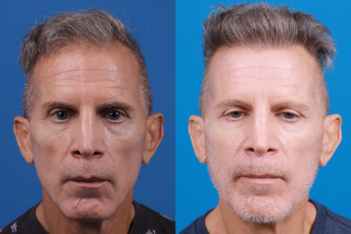 Hair Restoration Before & After Gallery - Patient 103873 - Image 1