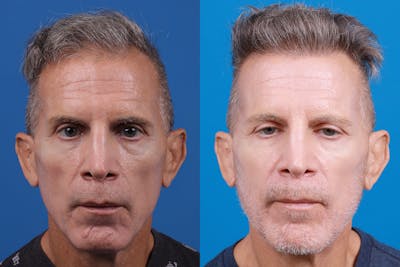 Hair Restoration Before & After Gallery - Patient 103873 - Image 1