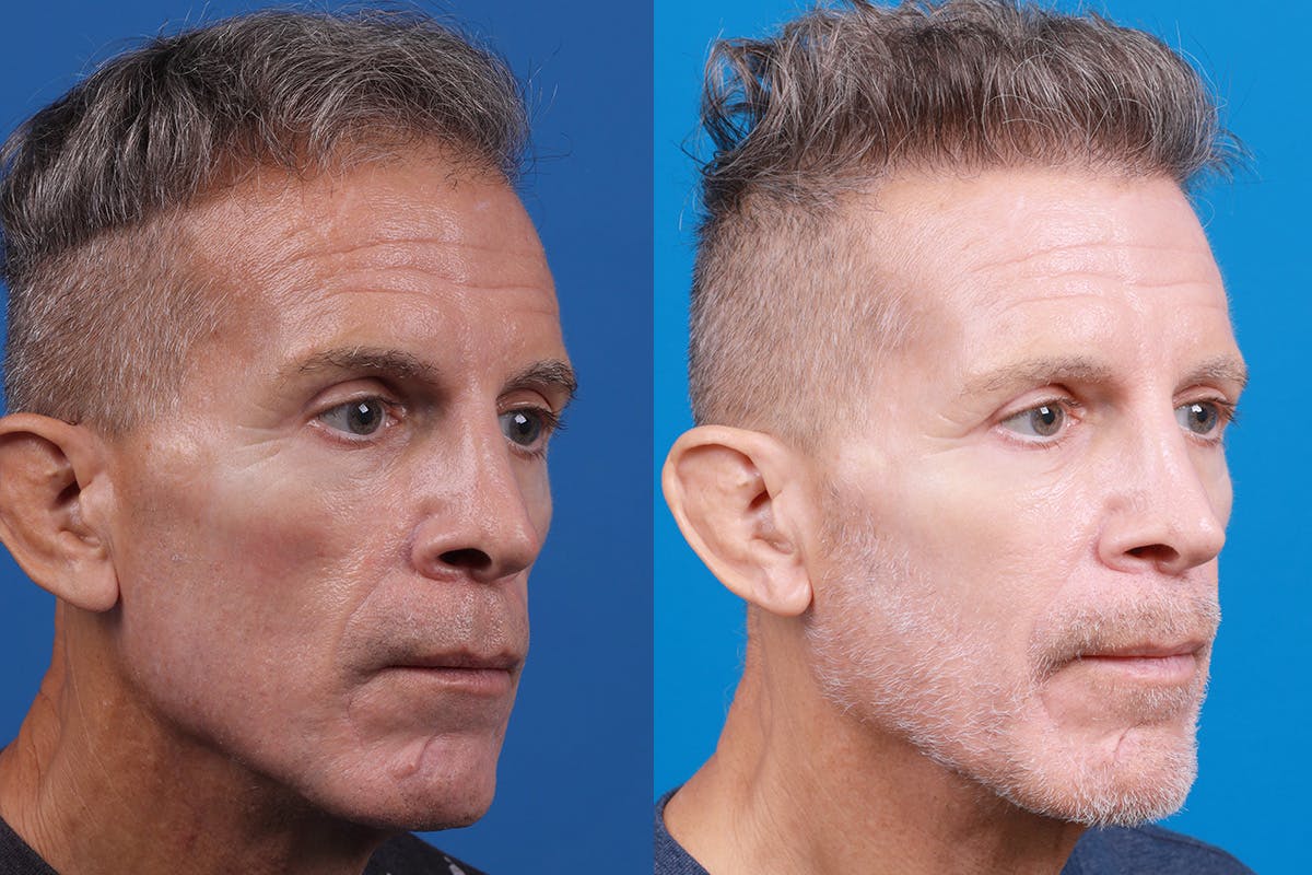 Hair Restoration Before & After Gallery - Patient 103873 - Image 2