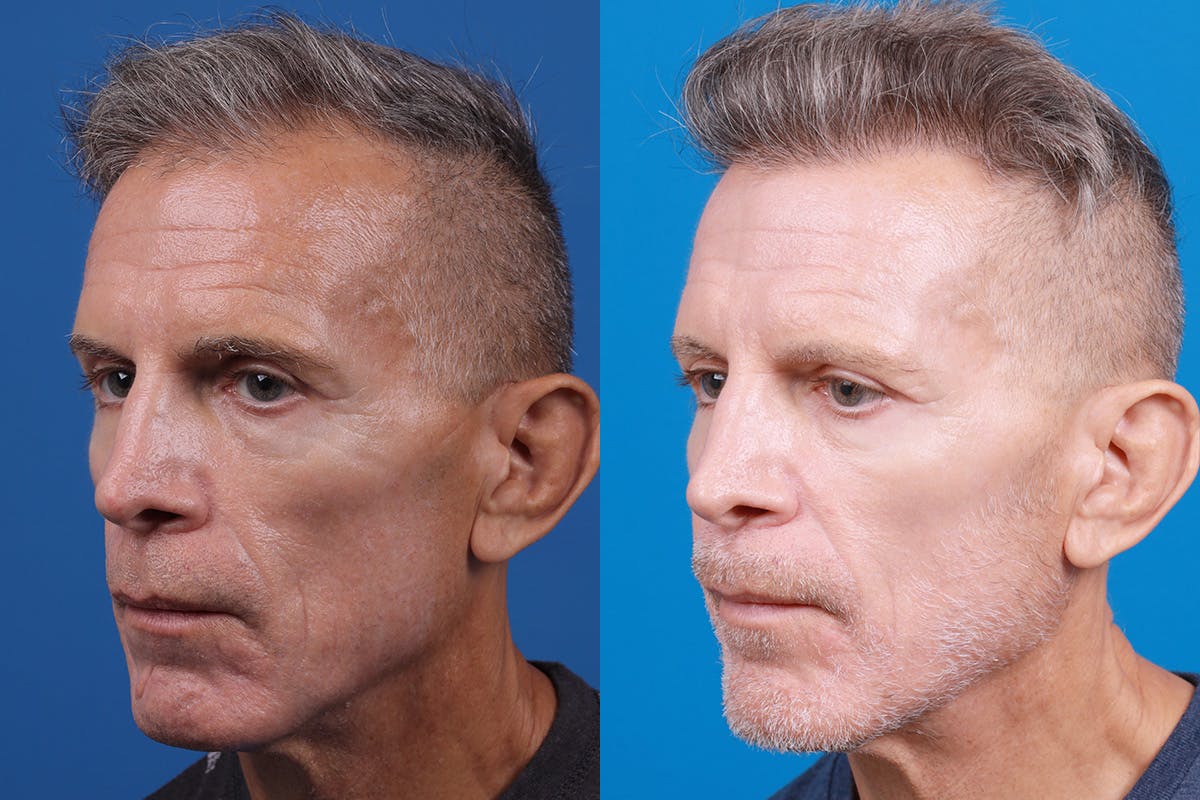 Hair Restoration Before & After Gallery - Patient 103873 - Image 4