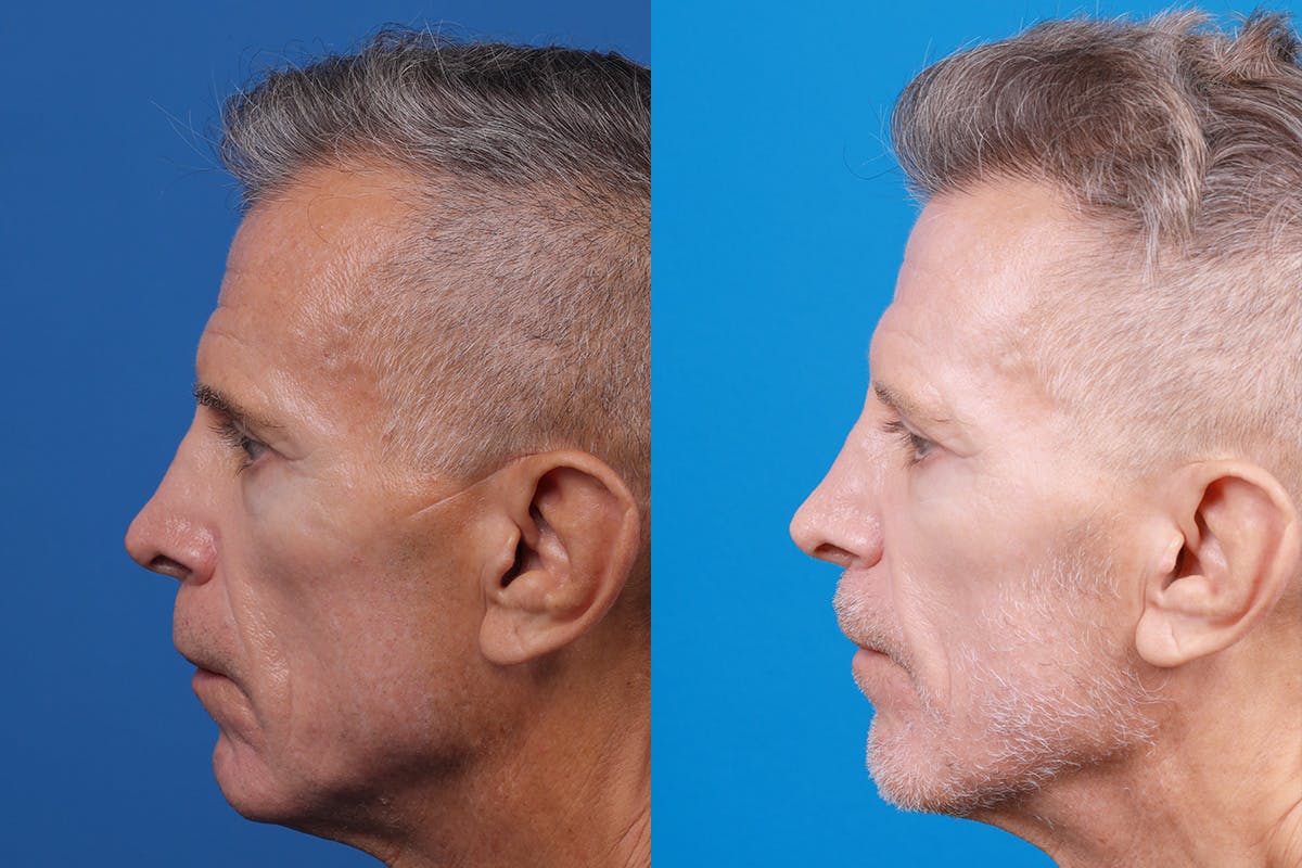Hair Restoration Before & After Gallery - Patient 103873 - Image 5