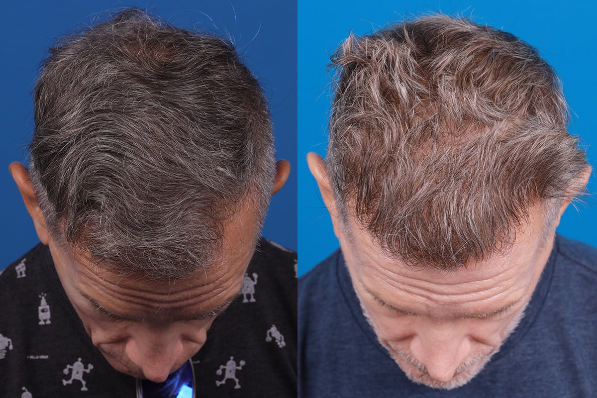 Hair Restoration Before & After Gallery - Patient 103873 - Image 6