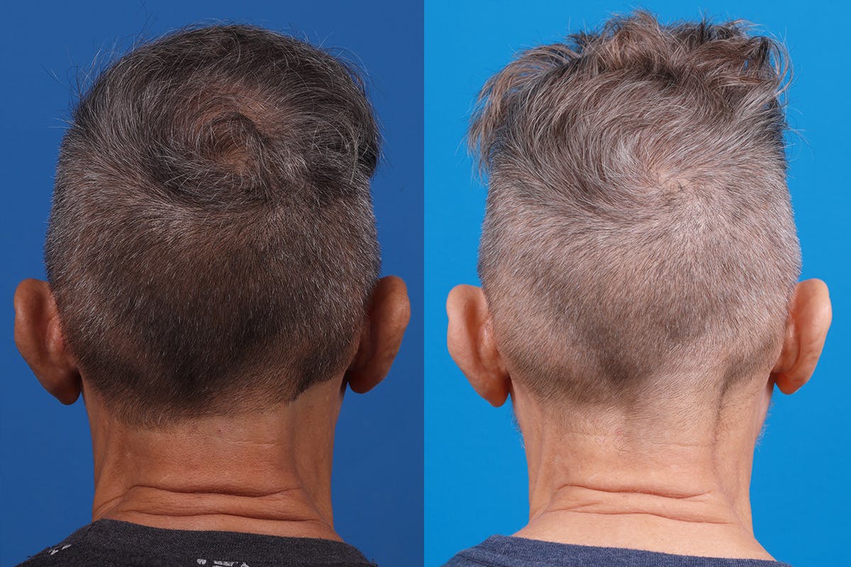 Hair Restoration Before & After Gallery - Patient 103873 - Image 7