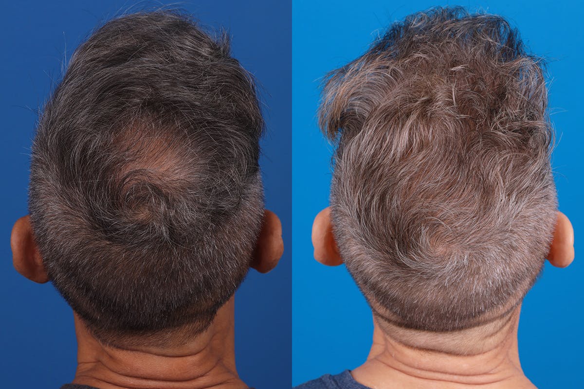 Hair Restoration Before & After Gallery - Patient 103873 - Image 8