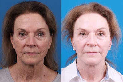 Facelift Before & After Gallery - Patient 427567 - Image 1