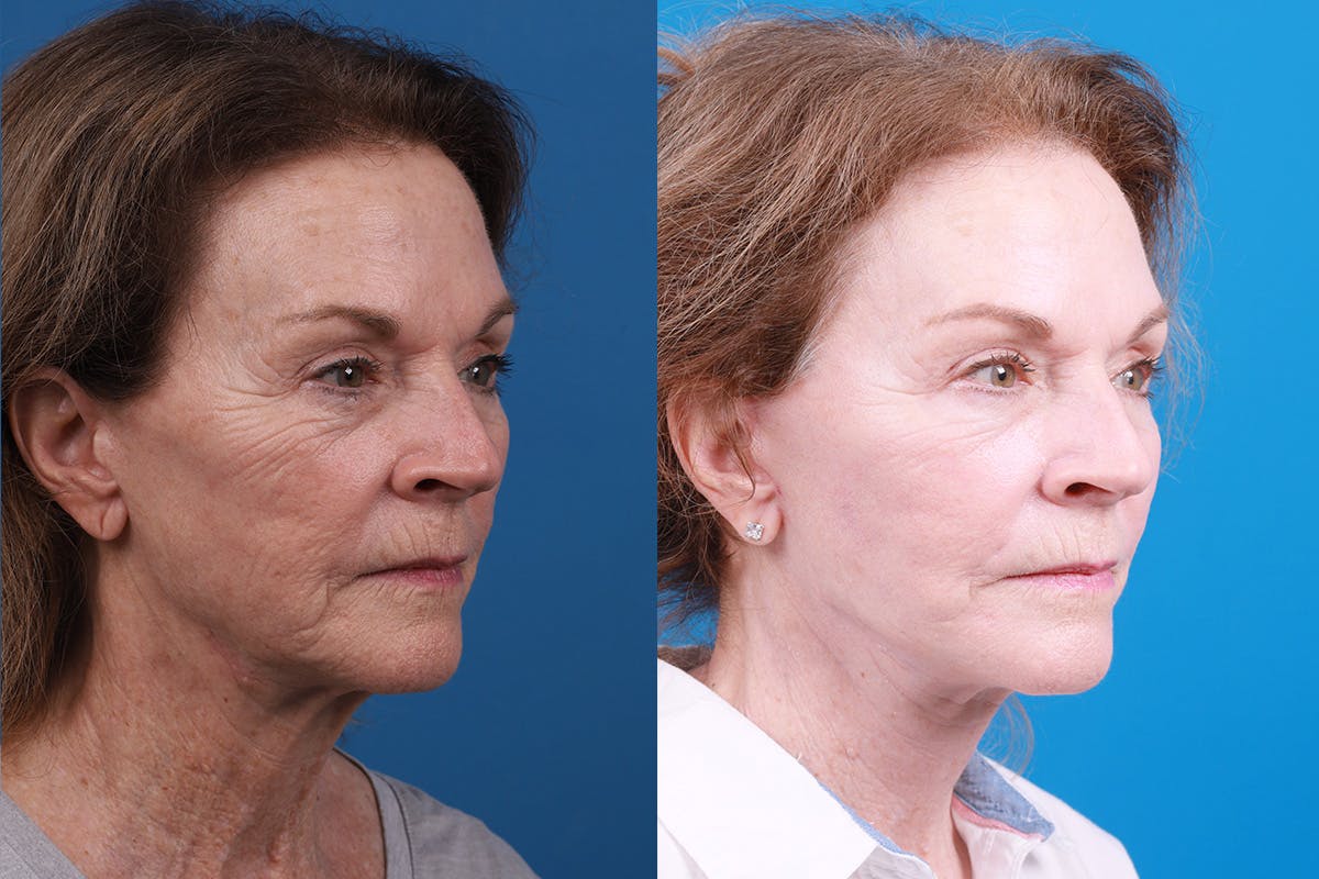 Facelift Before & After Gallery - Patient 427567 - Image 2