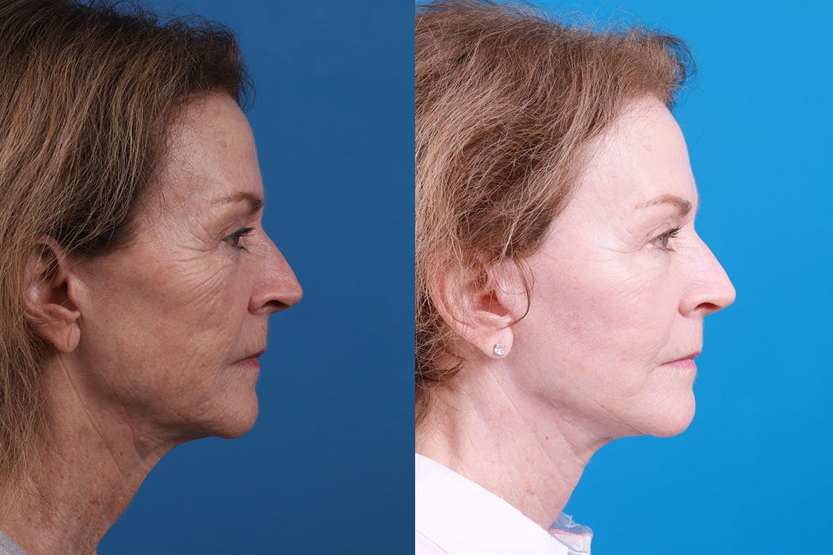Facelift Before & After Gallery - Patient 427567 - Image 3