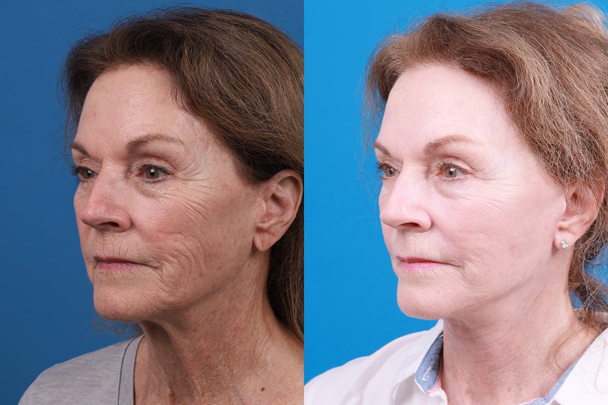 Facelift Before & After Gallery - Patient 427567 - Image 4