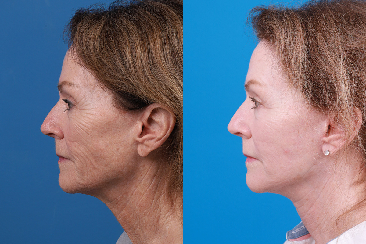 Skin Resurfacing Before & After Gallery - Patient 192618 - Image 5