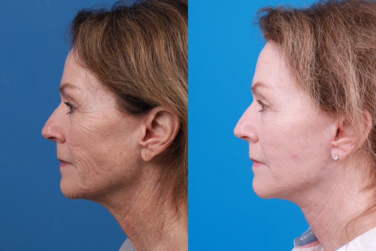 Facelift Before & After Gallery - Patient 427567 - Image 5