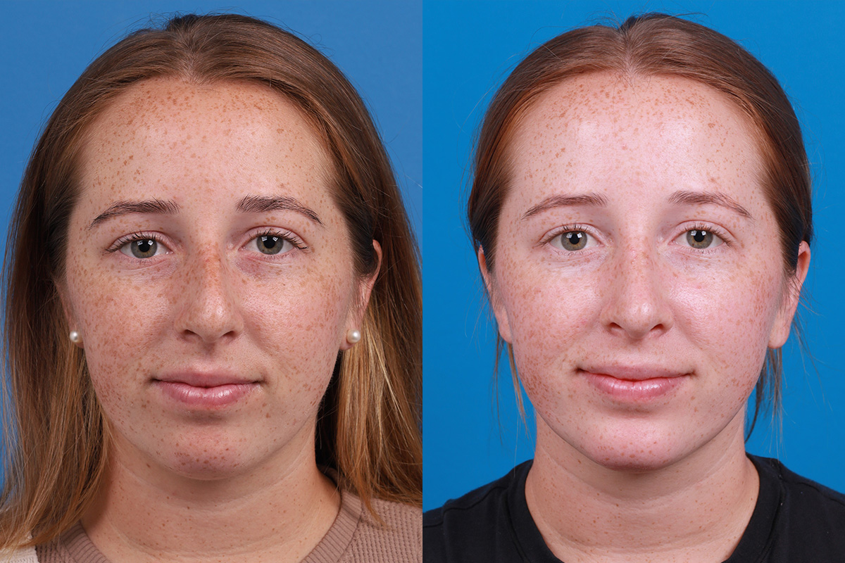 Chin Augmentation Before & After Gallery - Patient 137533 - Image 3