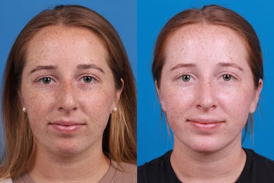 Rhinoplasty Before & After Gallery - Patient 128983 - Image 1