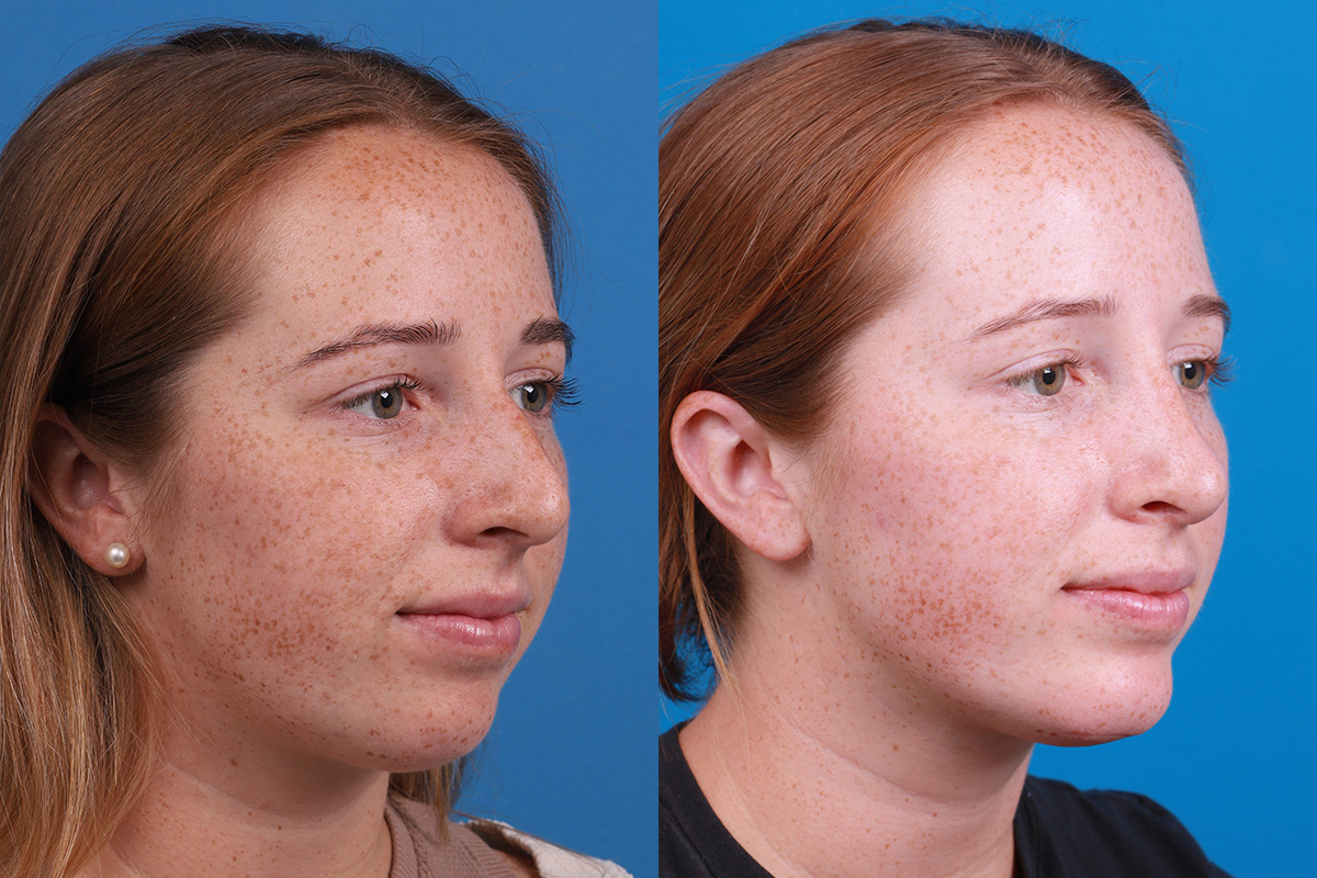 Chin Augmentation Before & After Gallery - Patient 137533 - Image 4
