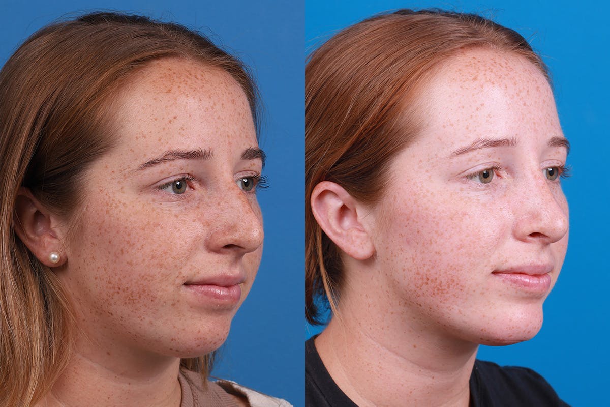 Chin Augmentation Before & After Gallery - Patient 137533 - Image 4