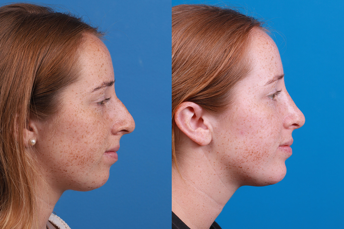 Chin Augmentation Before & After Gallery - Patient 137533 - Image 5