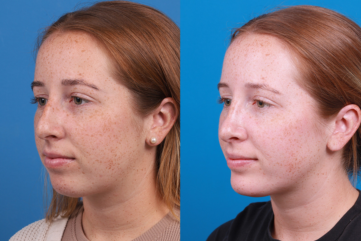 Chin Augmentation Before & After Gallery - Patient 137533 - Image 2