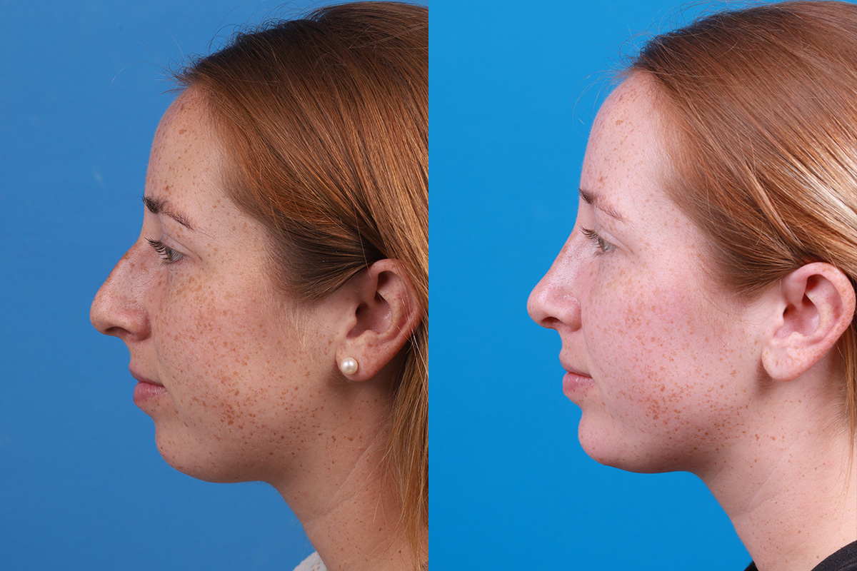 Chin Augmentation Before & After Gallery - Patient 137533 - Image 1